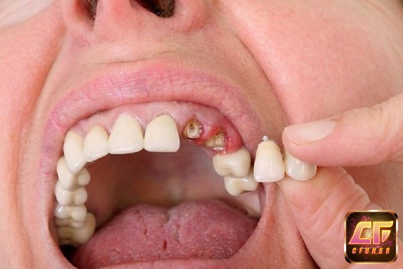 Điềm báo trong giấc mơ thấy rụng răng là gì?